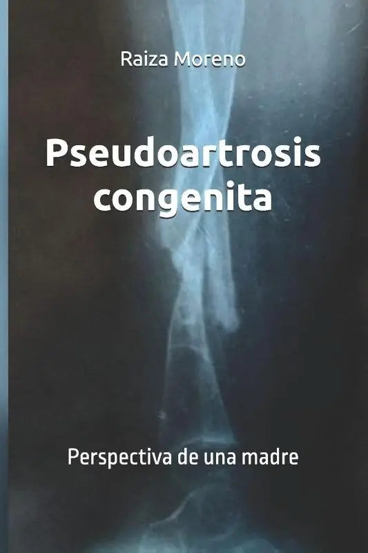 Pseudoartrosis congenita - Perspectiva de una madre