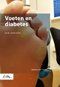 Close-up van voeten met zichtbare aderen en huidtextuur bij het product voeten en diabetes van bsl media paramedisch algemeen